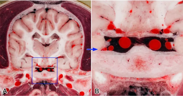 Fig 4. Transverse section at the mid-thalamic level (A). Blue frame on image (A) shows the zoomed region (B)