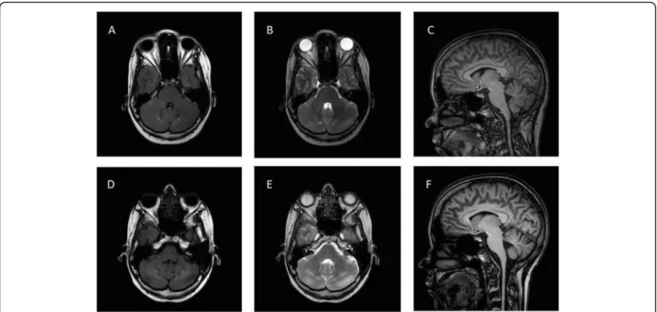 Fig. 3 Brain MRI of the patient. a (FLAIR horizontal), b (T2 horizontal) and c (sagittal horizontal) are MRI examinations performed in 2008, while d (FLAIR horizontal), e (T2 horizontal) and f (sagittal) was performed in 2016