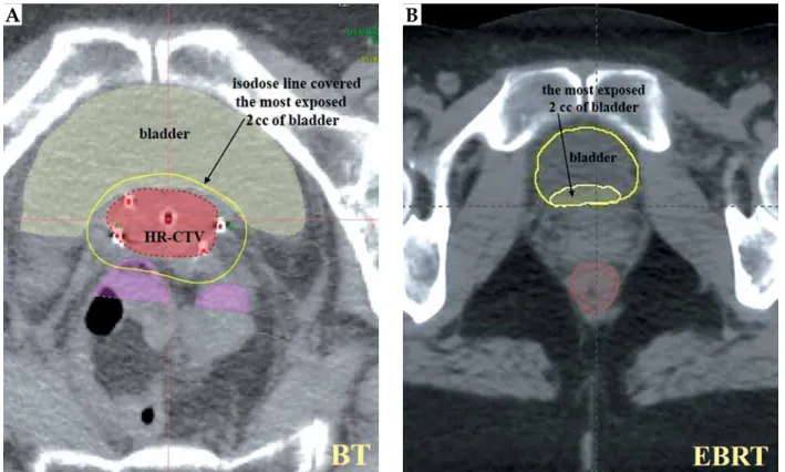 Fig. 1. The most exposed 2 cc of bladder in BT (A) contoured in EBRT CT (B) in an axial slice