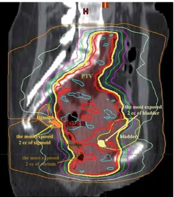 Fig. 4. The most exposed 2 cc of bladder (yellow), rectum  (brown), and sigmoid (orange) from BT in a sagittal CT  slice in an intensity-modulated arc therapy plan