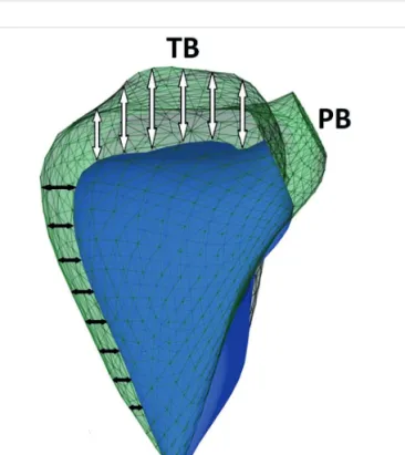 2. ÁBRA. A jobb kamrai mechanika (végdiasztolé: zöld háló, végszisztolé: kék modell). A prominens longitudinális (fehér nyíl) rövidülés mellett a körkörös rostok radiális (fekete nyíl) kontrakciója is lényeges tényező