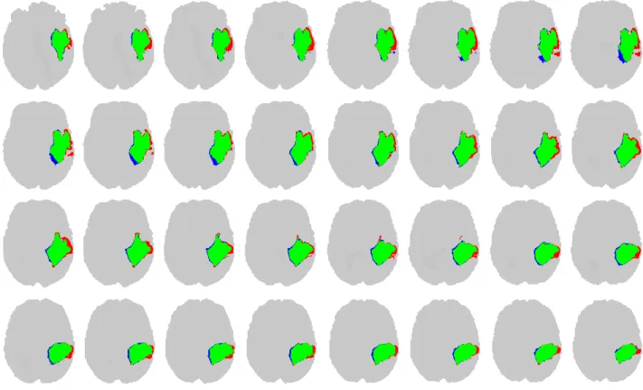 Fig. 5. Thirty-two consecutive slices of a LG tumor volume, indicating true positive (green), false positive (blue) and false negative (red) pixels.