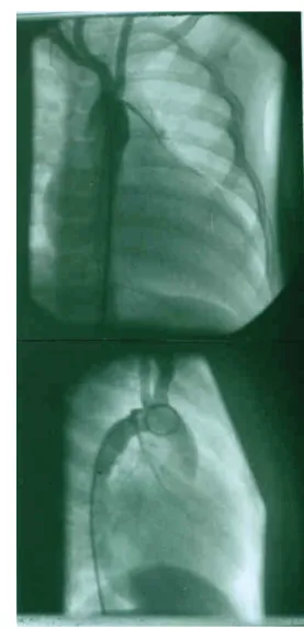1. ábra Arteria subclavia–LAD anasztomózis angiokardiográfiás képe  18 év után