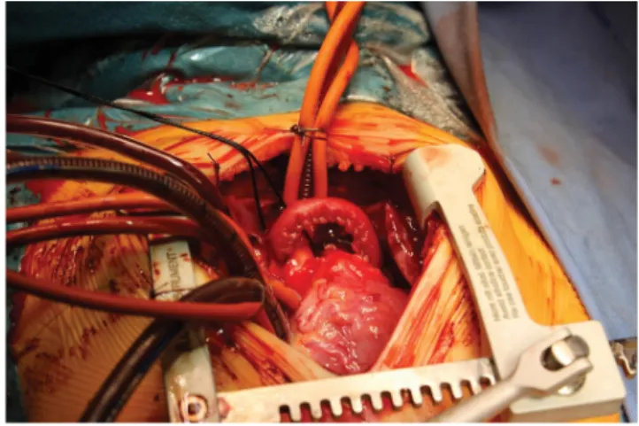 2. ábra Aorta–bal arteria coronaria kapcsolat kialakítása CorMatrix   csővel