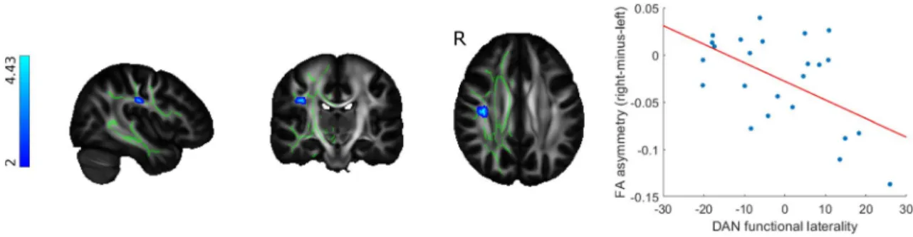 Fig. 4    Functional laterality changes in MS patients are connected to  white matter microstructural asymmmetry in the dorsal attention  net-work