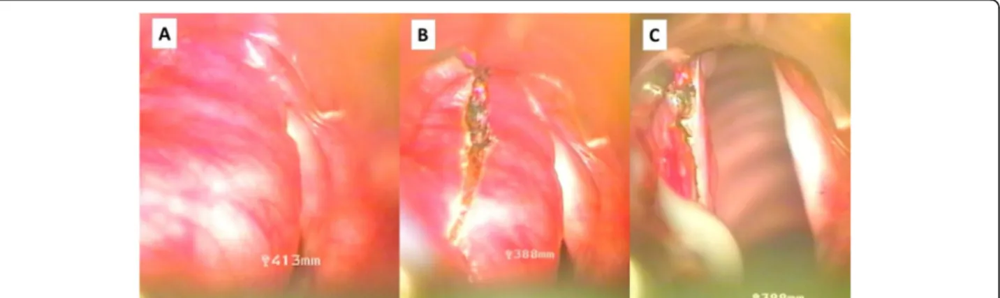 Fig. 2 Endoscopic surgery for congenital laryngocele - intraoperative photos. A: Cystic mass of the left false vocal cord cause severe obstruction.