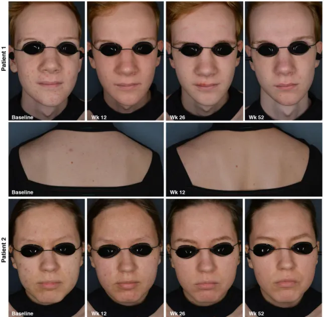 Figure 6 Acne severity of two patients at different time points. Patient n ° 1: Face, Acne severity on the face decreased from an IGA score of 3 to an IGA score of 1 at 12 weeks; Trunk, Acne severity on the trunk decreased from a PGA score of 3 to a PGA sc