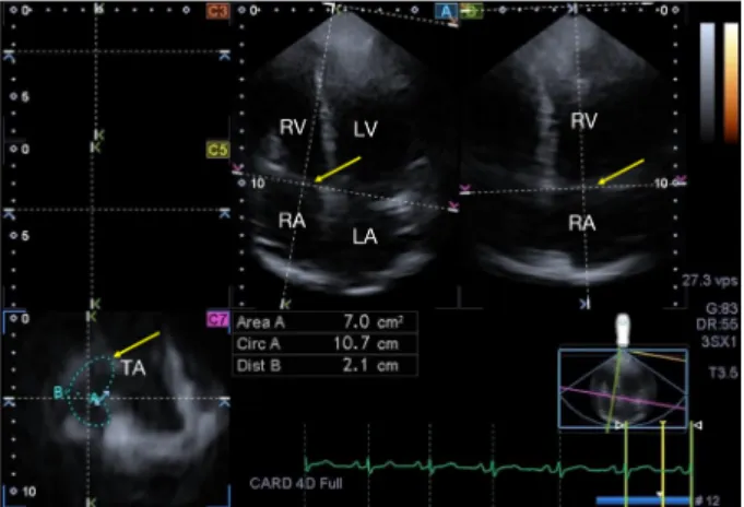Figure 2 Some examples of deformed tricuspid annuli. Yellow  arrows represent the tricuspid annular plane.