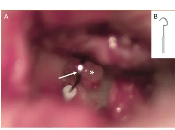 5. ábra A: az incus hosszú szárán (fehér *) rögzített teflonpiston intra- intra-operatív helyzete (fehér nyíl) látható