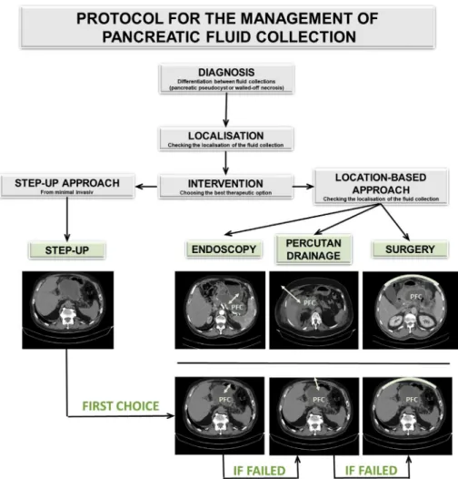 Fig. 4. Suggested protocol for the treatment of pancreatic ﬂuid collections. (PFC¼ pancreatic ﬂuid collection, white arrows indicate the suggested site of intervention).