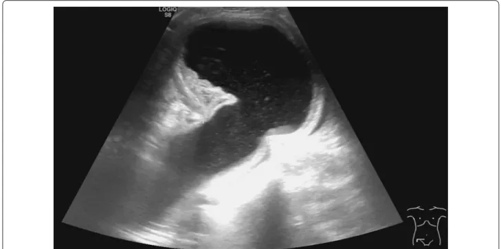 Fig. 1  Preoperative abdominal ultrasound showed an oedematous intestinal loop in a 70-mm-long hernial sac protruding via a 30-mm hernial  orifice