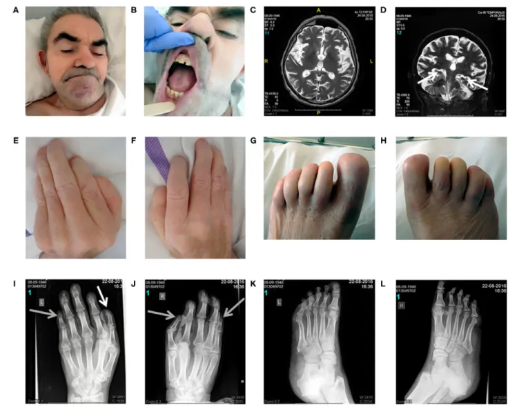 FIGURE 1 | Clinical and radiomorphological characteristics of an aged case of DOORS syndrome