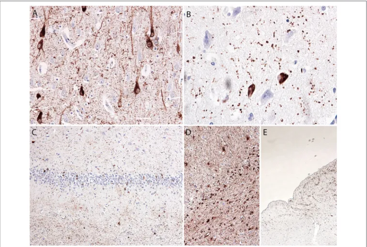 FIGURE 2 | Microscopic postmortem neuropathological alterations of an aged patient with DOORS syndrome
