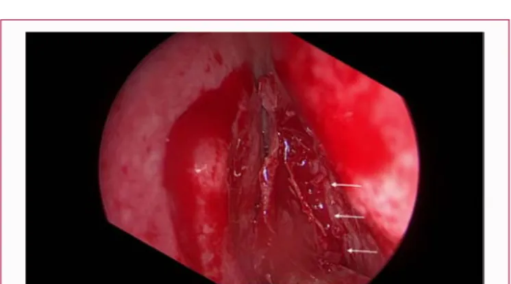 Figure 6: Vertical incision on the septum, creating a muco-periosteal flap on  the right and the left side.
