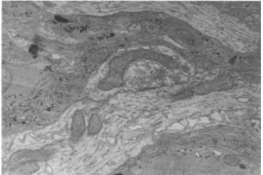 FIGURE 2 Ultrastructure of a Brain Aggregate. A clear  vesicle containing synaptic complex surrounded by more electron  dense glial processes is present