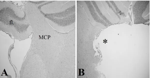 12. ábra: a coronalis síkú metszeteken a MCP és a lobus floccularis kiesése látható (B) az ép  oldalhoz képest (A)