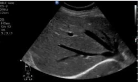 Figure 4. Normal liver on US  3.2.5. The types of echo structures 