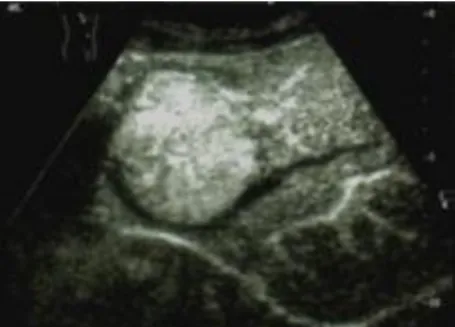 Figure 11. HCC, CEUS, small late (35s) arterial filling  3.4. Tissue Harmonic Imaging - THI 