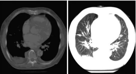 Figure 3.: The same CT image with soft tissue window (a) and lung window (b)     