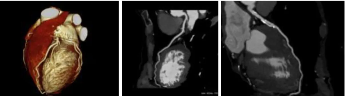 Fig. 3., 4., 5.: CT coronarography: Normal anatomy, volume rendered image and curved  reformatted image Plaque causing stenosis on LAD coronary artery 