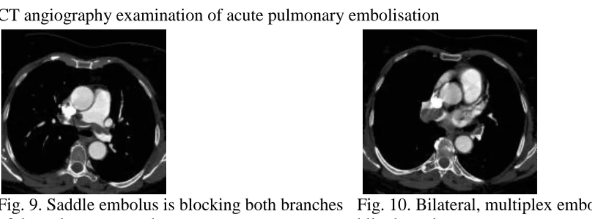 Fig. 9. Saddle embolus is blocking both branches  of the pulmonary trunk  