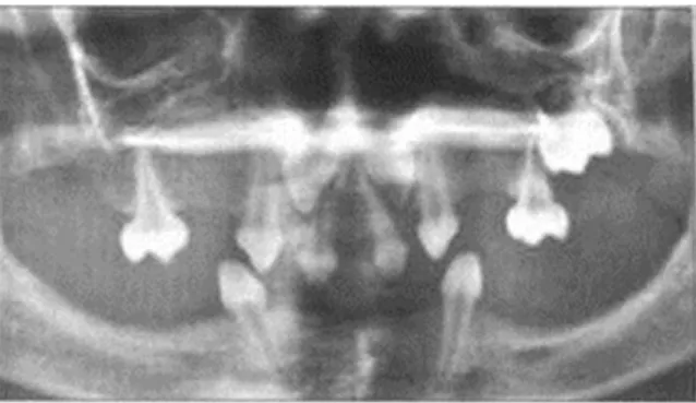 Figure 1.12. Figure 12. – Oligodontia in a human patient with hypohydrotic ectodermal  dysplasia (HED) – The ectodysplasin gene is crucial for tooth development