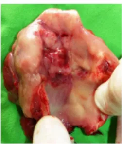Figure 10.: Laryngeal tumour of Supraglottic origin (operative preparation – complete larynx)