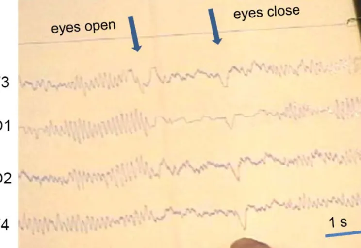 Fig. 2. Paper recorded EEG demonstrating desynchronization  induced by eye opening. The 2-5