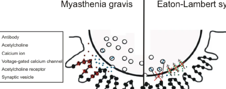Figure 7. Myasthenia gravis - Antibodies block the acetylcholine receptors  therefore acetylcholine can not bind to the receptors to generate muscle  contraction (left side of the figure)