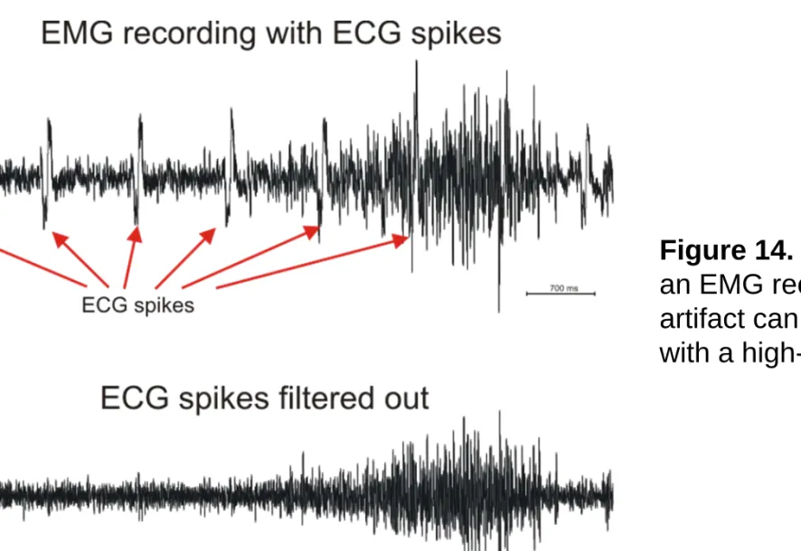 Figure 14. ECG artifact on an EMG recording. The artifact can be filtered out with a high-pass filter