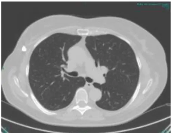 3. ábra: Korábbi mellkas CT-vizsgálat_ax/tüdőablak/  