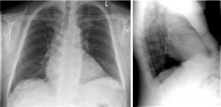 1., 2. ábra: Mellkasröntgen vizsgálat     