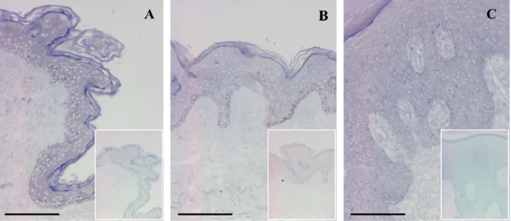 Figure 2. Detection of PRINS expression in psoriasis.  ISH for PRINS expression was  performed on healthy normal (n = 10), psoriatic uninvolved (n = 6) and psoriatic involved  (n = 6) skin specimens