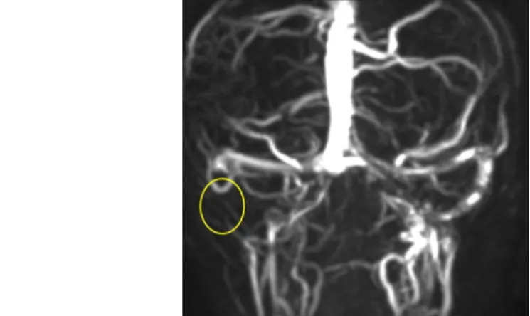 16. ábra: Korábban cholesteatoma miatt radikális fülműtéten átesett betegnél a radicalis üregben kialakult carcinoma planocellulare