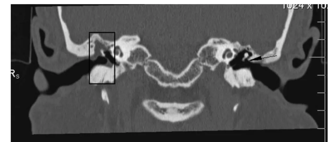 10. ábra: A bal oldalon légtartó dobüreg, a jobb oldalon a dobüreg epitympanalis részét cholesteatoma massza tölti ki, mely a hallócsontokat is körülveszi (téglalappal jelölve)