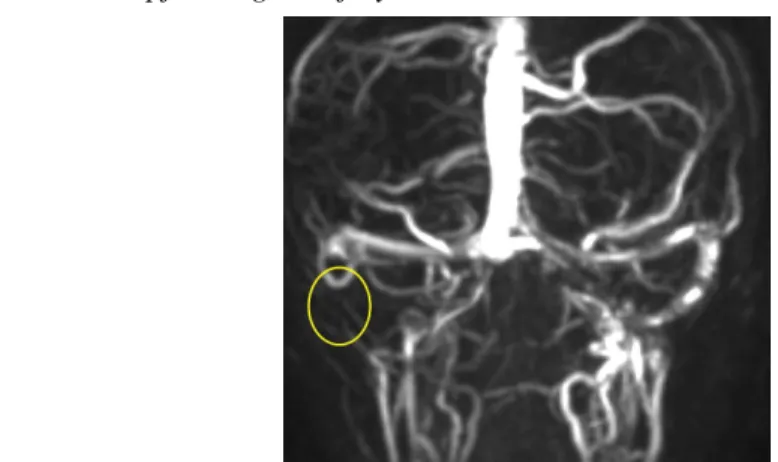 14. ábra: Szövődményes középfül gyulladás MR képe: pyramiscsúcs gennyedés (sárga körrel jelölve), a bal