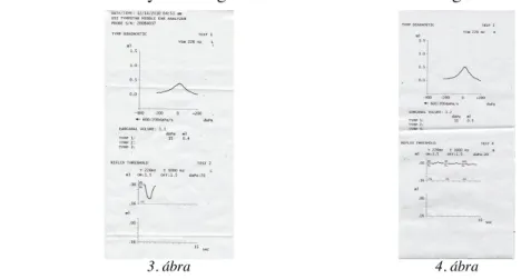 3-4. ábra: Stapedius reflex vizsgálat: jobb oldali ipszilaterális stapedius reflex hiány