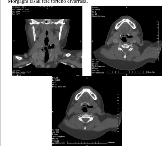 3-5. kép: Bal oldali laryngokele CT képe sagitális és horizontális síkban.