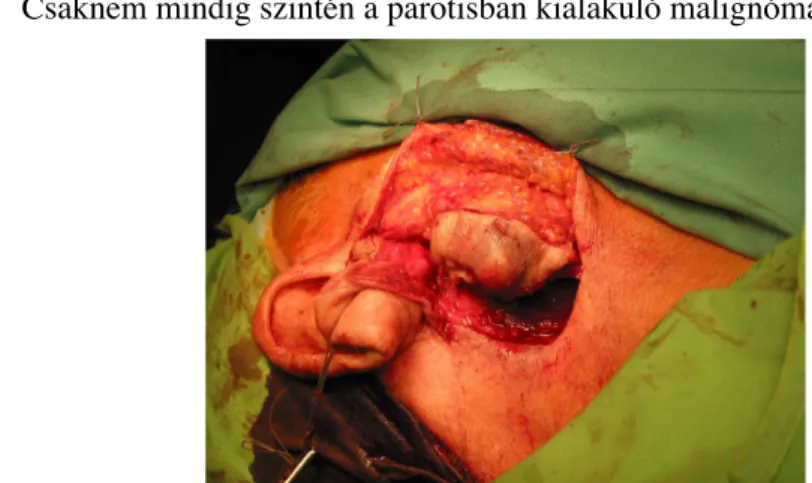 11. kép: Malignus jobb oldali parotis tumor excisiója az infiltrált bőrrel együtt.