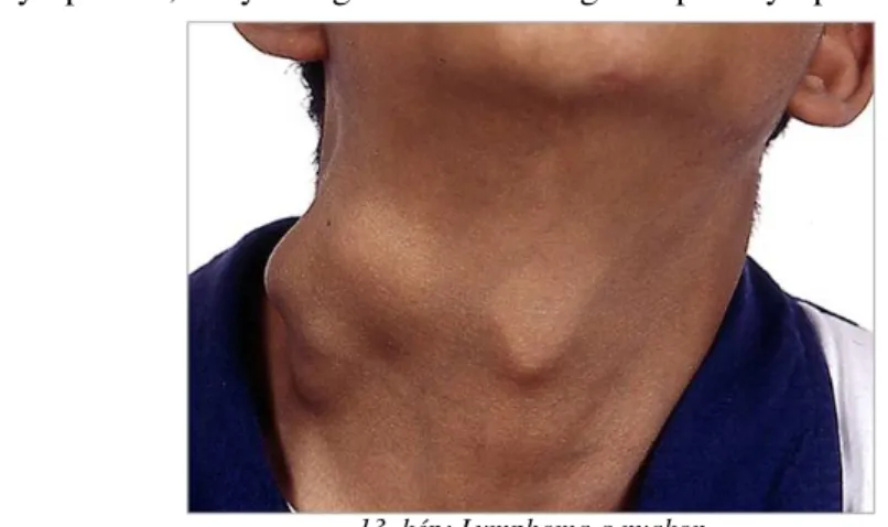 13. kép: Lymphoma a nyakon