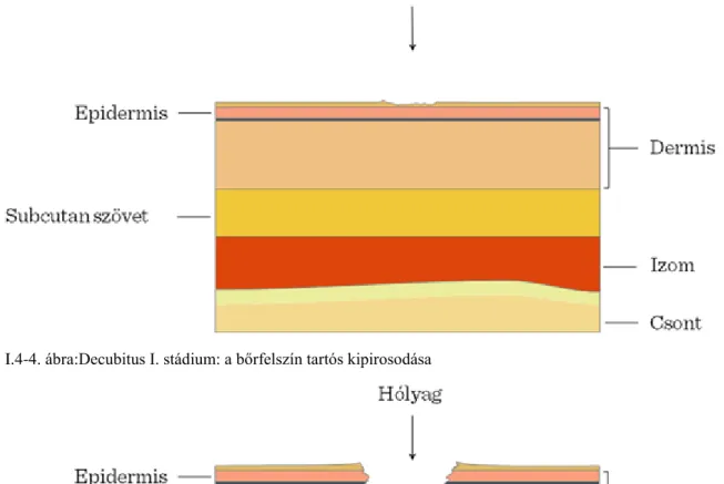 I.4-5. ábra:Decubitus II. stádium: felületes seb, nem éri el a szubkután szöveteket