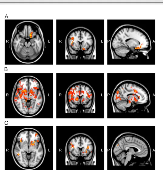 Fig. 1 – Brain regions of significantly increased activity in the obese group relative to the controls in response to 0.1 M sucrose (A), 0.03 mM quinine HCl (B), and to the vanilla flavored high-calorie (C) stimulus