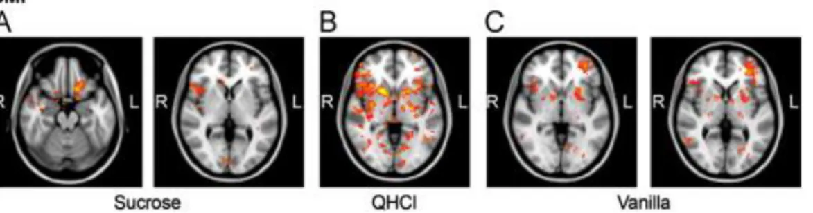 Fig. 2. Brain regions positively correlating with BMI for the sucrose (A), quinine-HCl  (B), and for the vanilla condition (C) (for more details see Results Section 2.2)