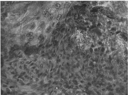 FIG. 2. Section of invasive tumor in gut of Periplaneta.  T h e tumor cells are small  and in places grow in whorls
