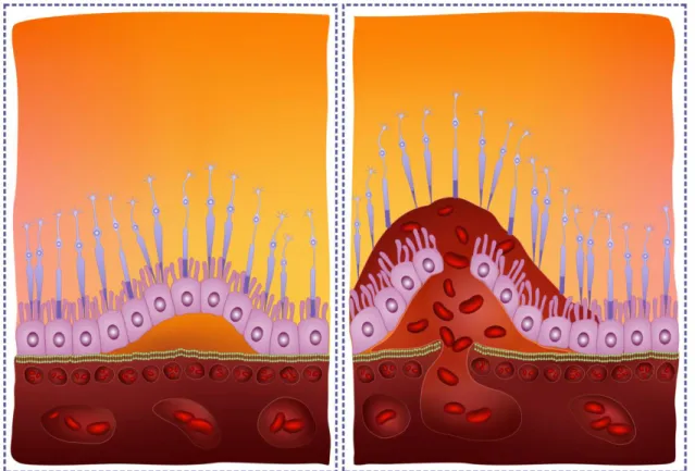 Figure 7.1. Age-related macular degeneration (AMD) 