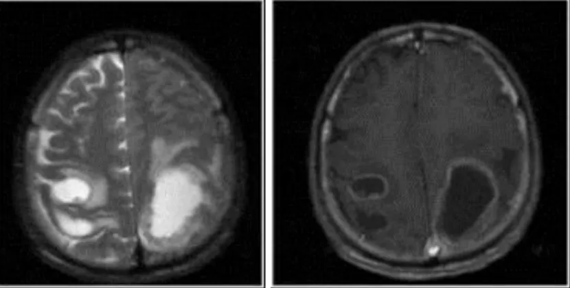 14. ábra. Vaskos, halmozó falú agytályogok mérsékelt perifocalis oedemával. (T2W, T1W+C)