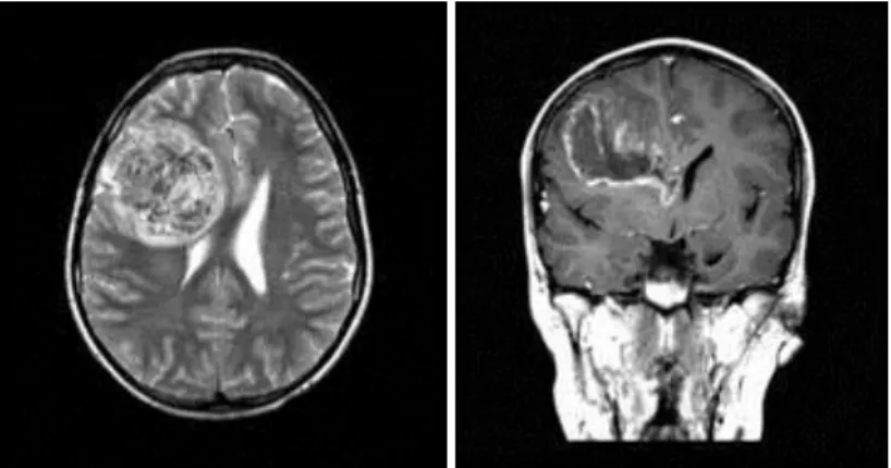 26. ábra. Multiplex, a T2W képeken közepes és alacsony jelintenzitású, kifejezett perifocalis oedemával övezett,  a kontrasztanyagot kissé inhomogénen felvevő térfoglalás képe – lymphoma