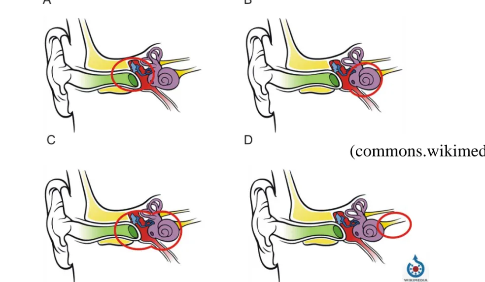 Figure 10. Damaged structures in different types of hearing disorders. A – Conductive hearing loss, B – Sensorineural hearing loss, C – Mixed hearing