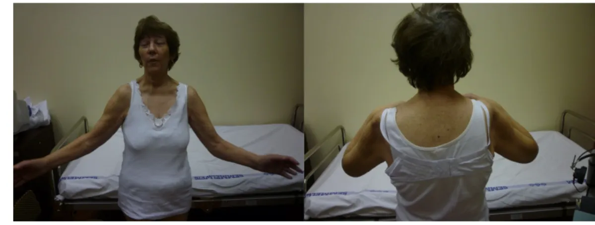 Fig. 2 and 3: Paresis and muscle atrophy in polymyositis.]]