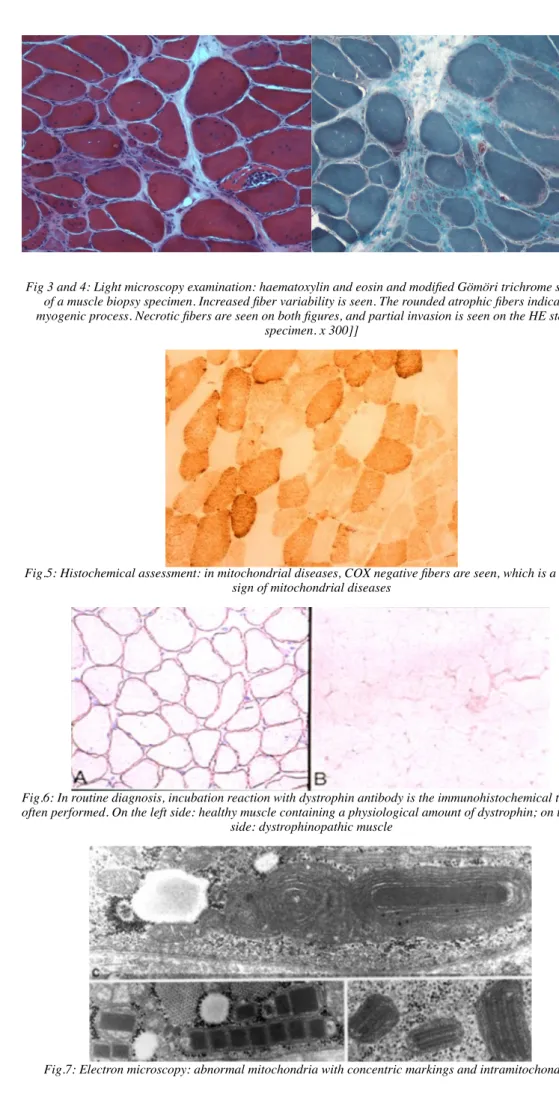 Fig 3 and 4: Light microscopy examination: haematoxylin and eosin and modified Gömöri trichrome staining of a muscle biopsy specimen